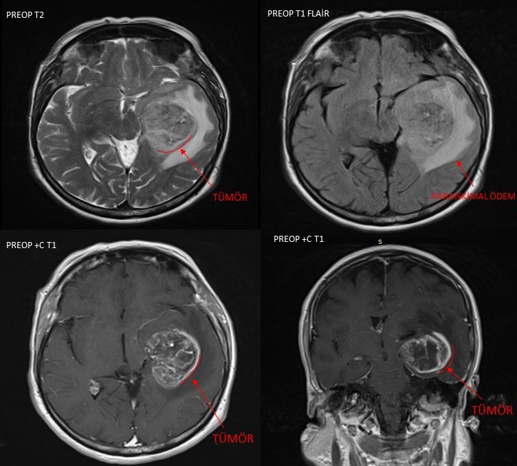 Preoperative MRI