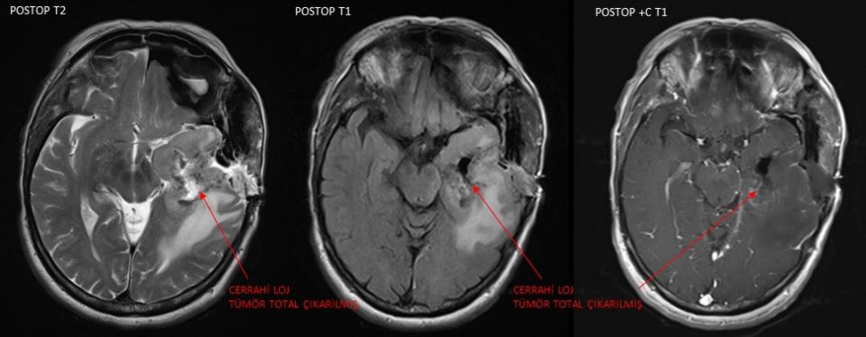 Intraoperative and postoperative MRI